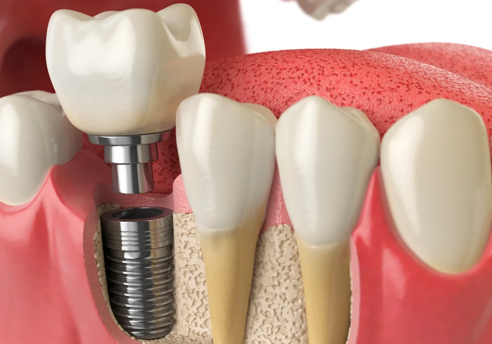 Implante Dentário CIPP odontologia São Carlos Dentista